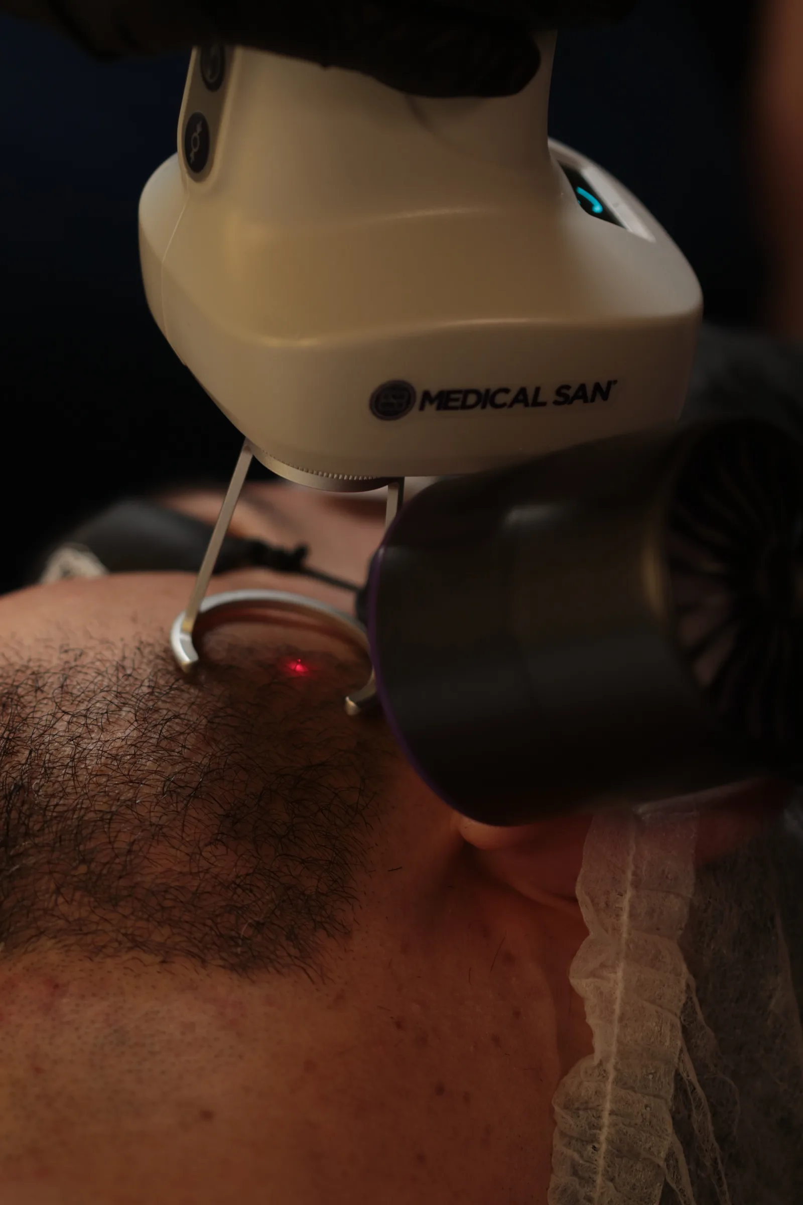 Sessão de depilação a laser na região da barba na MYL Barber Clinic