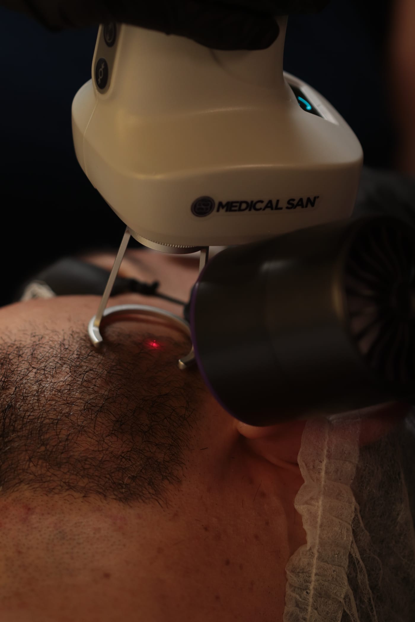 Sessão de depilação a laser na MYL Barber Clinic